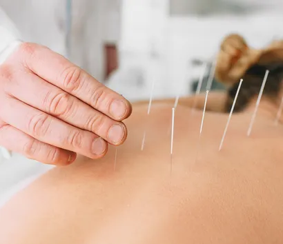 What Makes Rapharehab Offer the Best Acupuncture in Etobicoke?